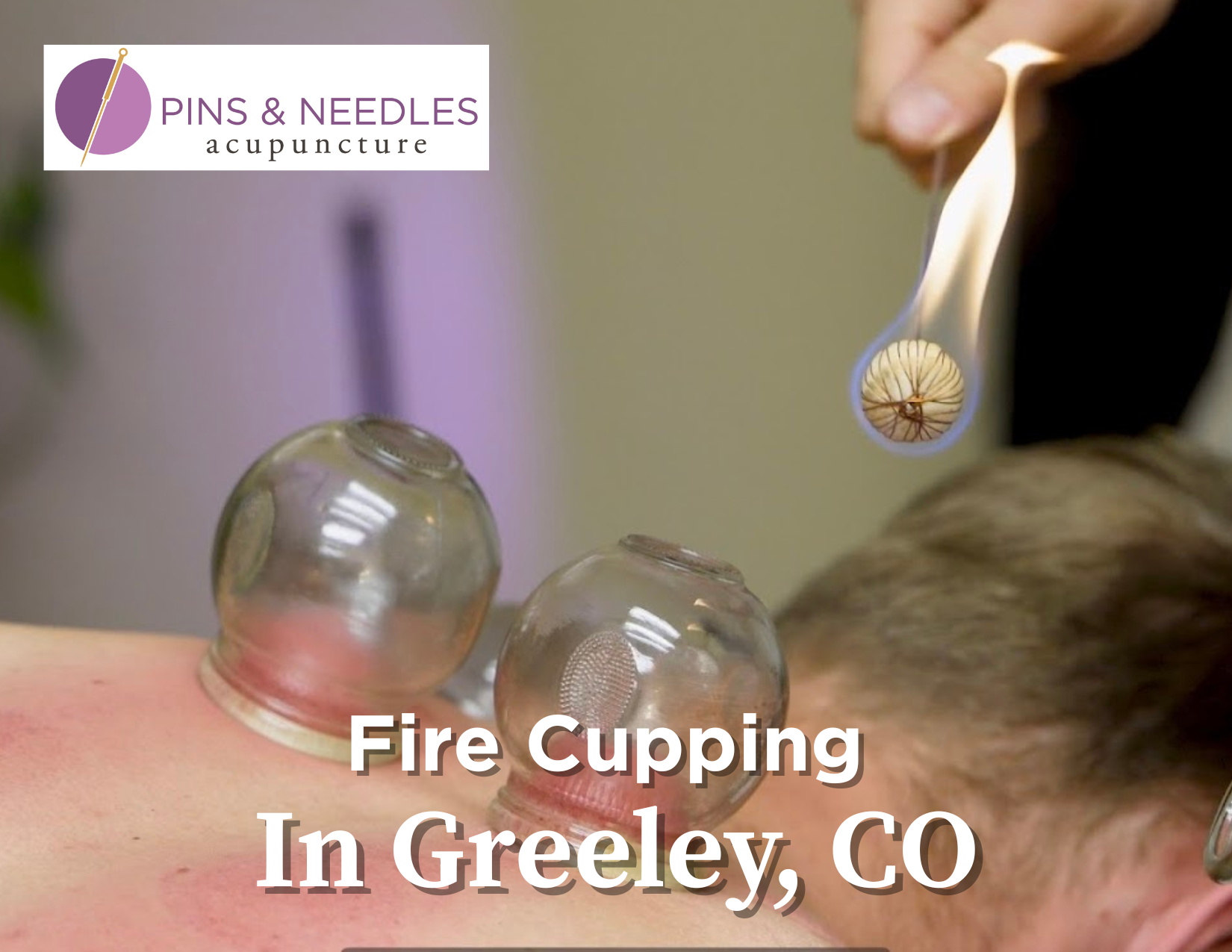 Fire Cupping in Greeley: How It Works, Who It Helps, and Why People Love It