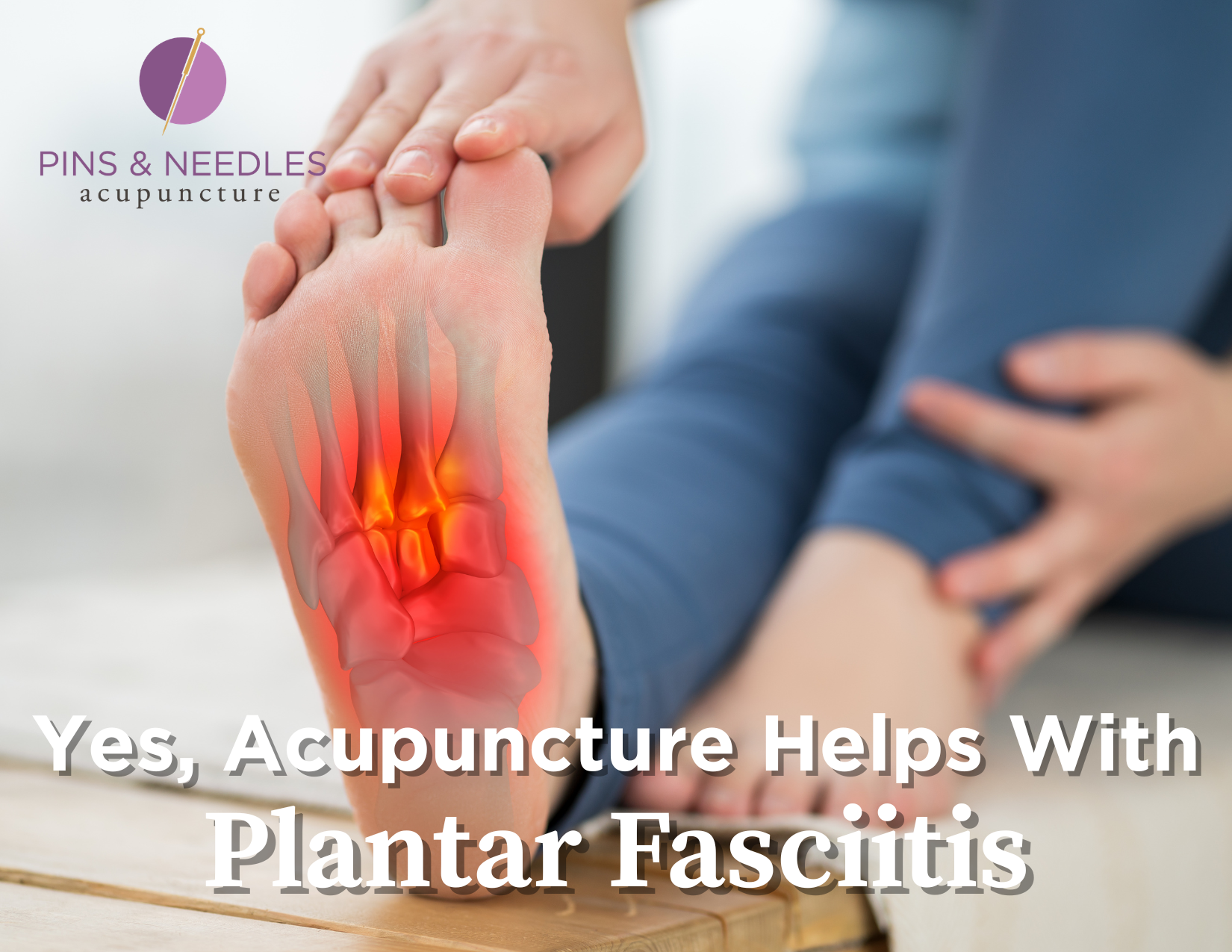 Yes, Acupuncture Helps Plantar Fasciitis — Here’s How We Treat It in Greeley, CO