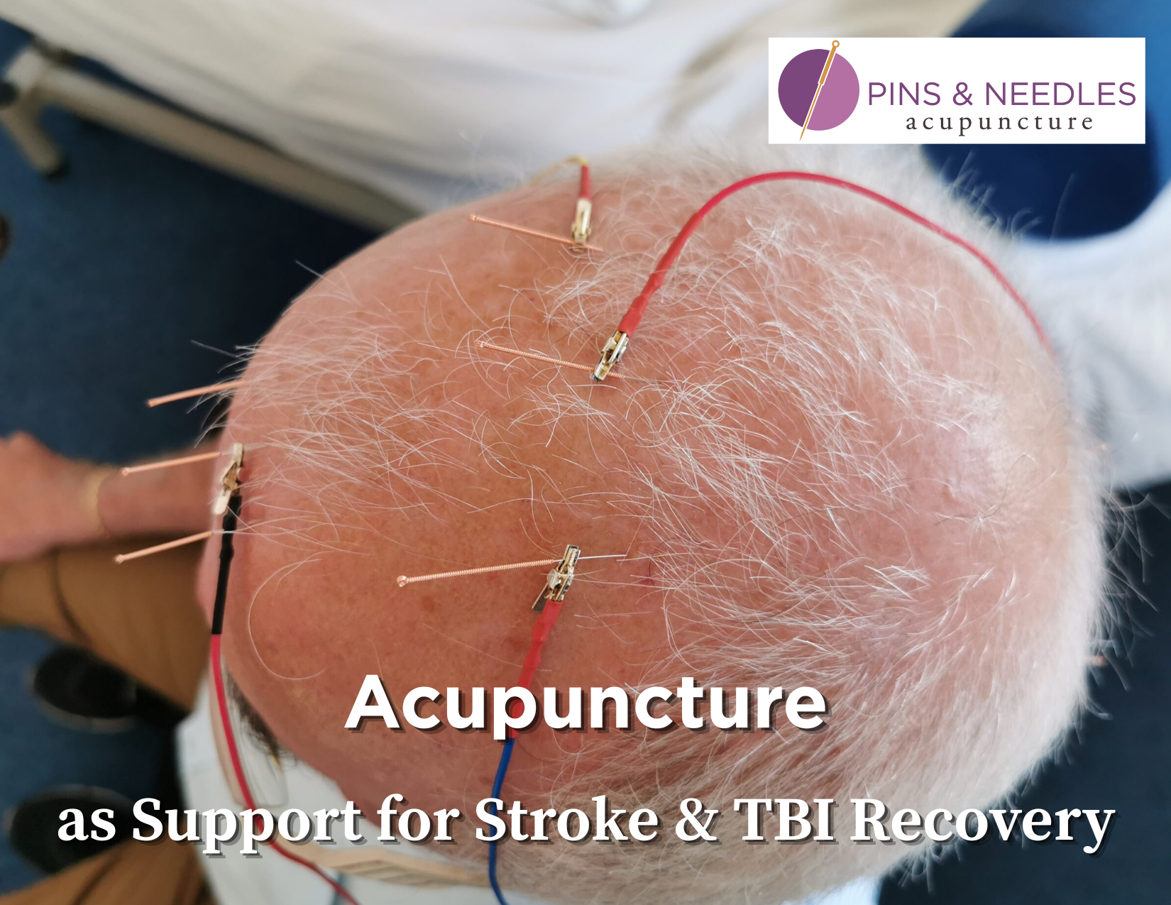Acupuncture as Support During Stroke or TBI Recovery: How Scalp Acupuncture Helps in Greeley, CO