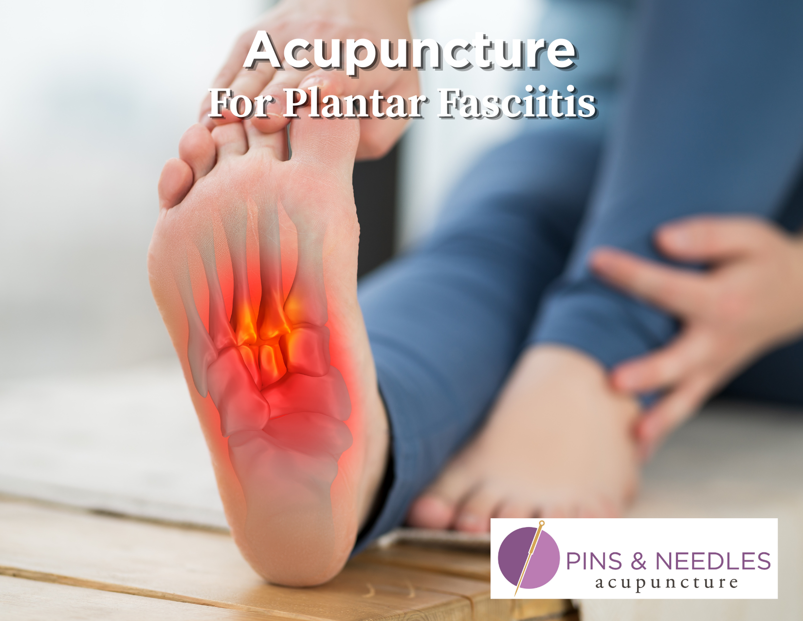 Acupuncture for Plantar Fasciitis: Natural Relief for Heel Pain in Northern, CO