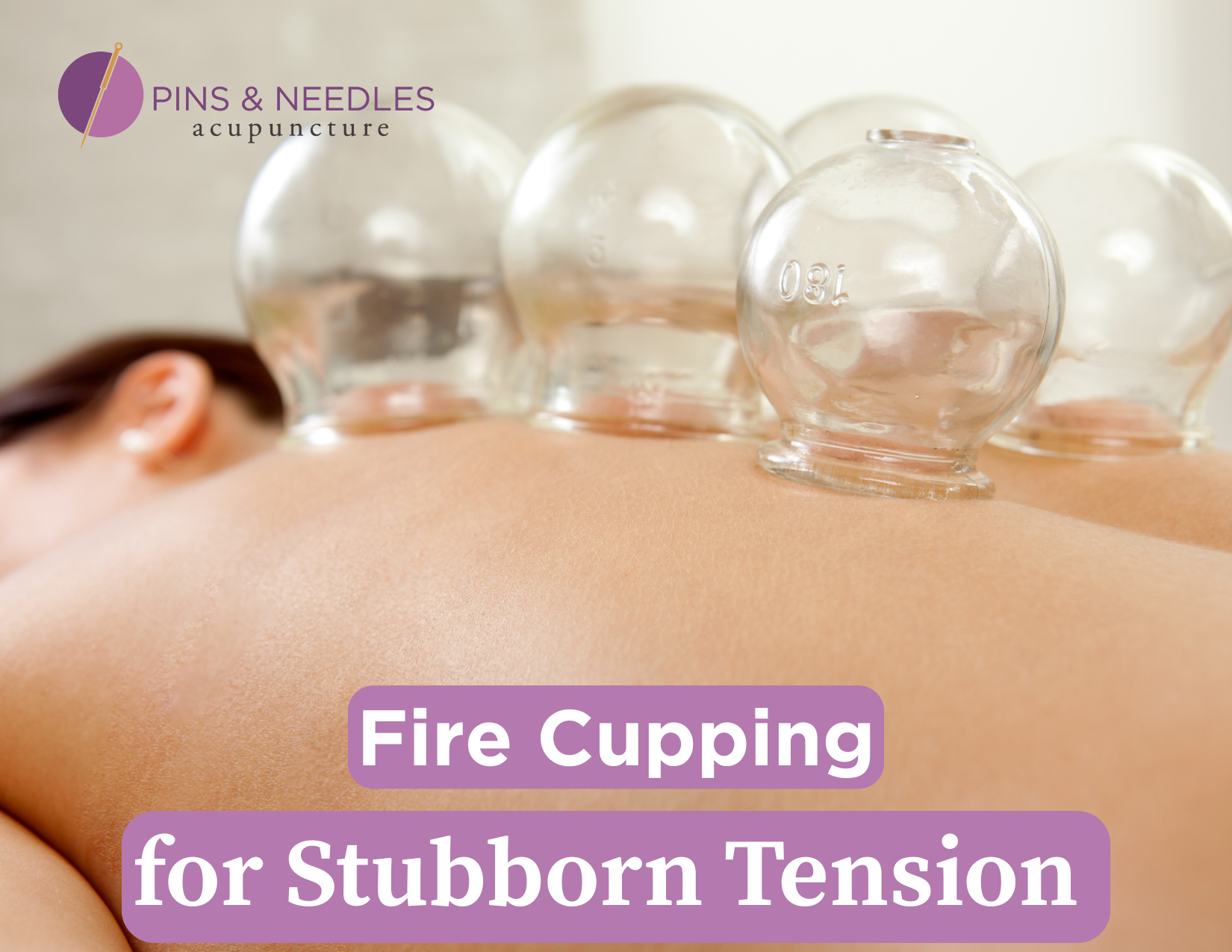 Person with cups on their back for muscle tension relief