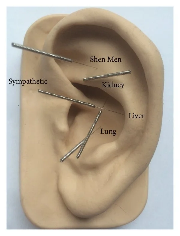 AcuDetox with NADA Protocol. 5 specific points on the ear that correspond to areas of the body and emotions.