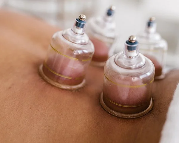 cupping therapy on back
