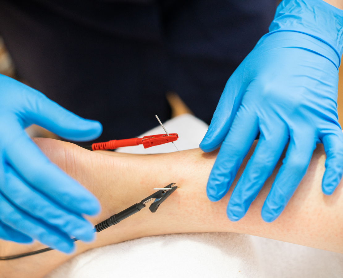 What Is Dry Needling? How It Unlocks Stubborn Muscle Knots