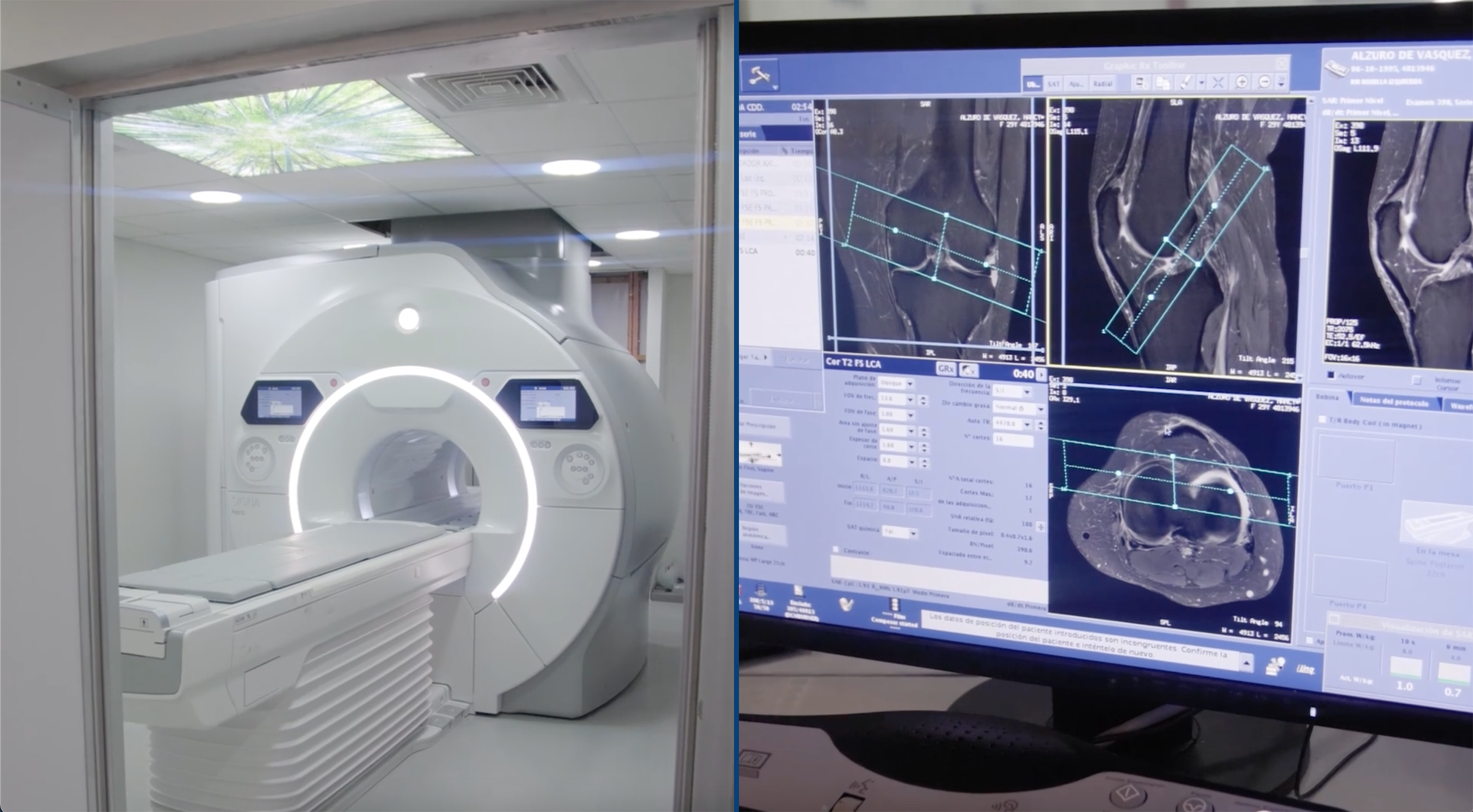 Imagen dividida en dos, a la izquierda una máquina de resonancia magnética y a la derecha una pantalla con resultados de una resonancia, mostrando imágenes médicas en escala de grises con líneas de medición y datos técnicos.