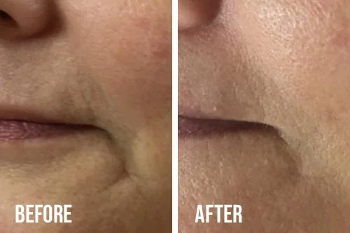 microneedling-before-after-3.jpg