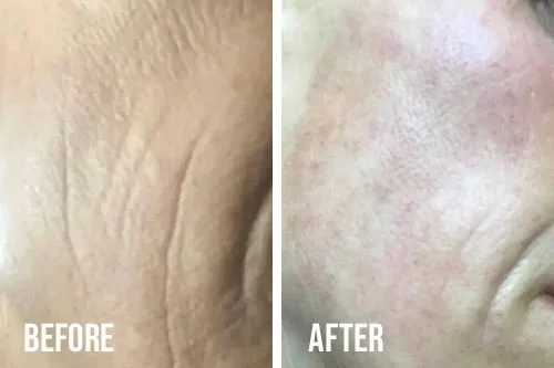 microneedling-before-after-2.jpg