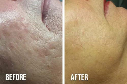 microneedling-before-after.jpg