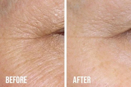 microneedling-before-after-5.jpg