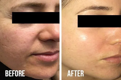 microneedling-before-after-4.jpg