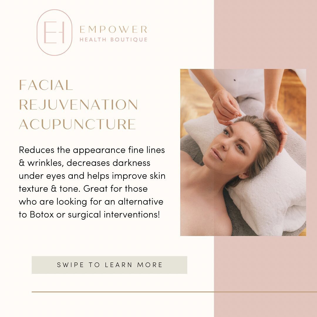 ✨Facial Rejuvenation Acupuncture✨

AKA cosmetic acupuncture, reduces premature aging naturally. Great for those who are looking for an alternative to botox or surgical interventions!

Skin in stimulated by inserting fine needles into specific points 