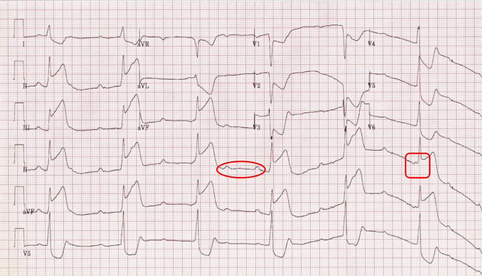 An Interesting ECG Case -Inferoposterior STEMI with CHB — Manitoba ACS ...