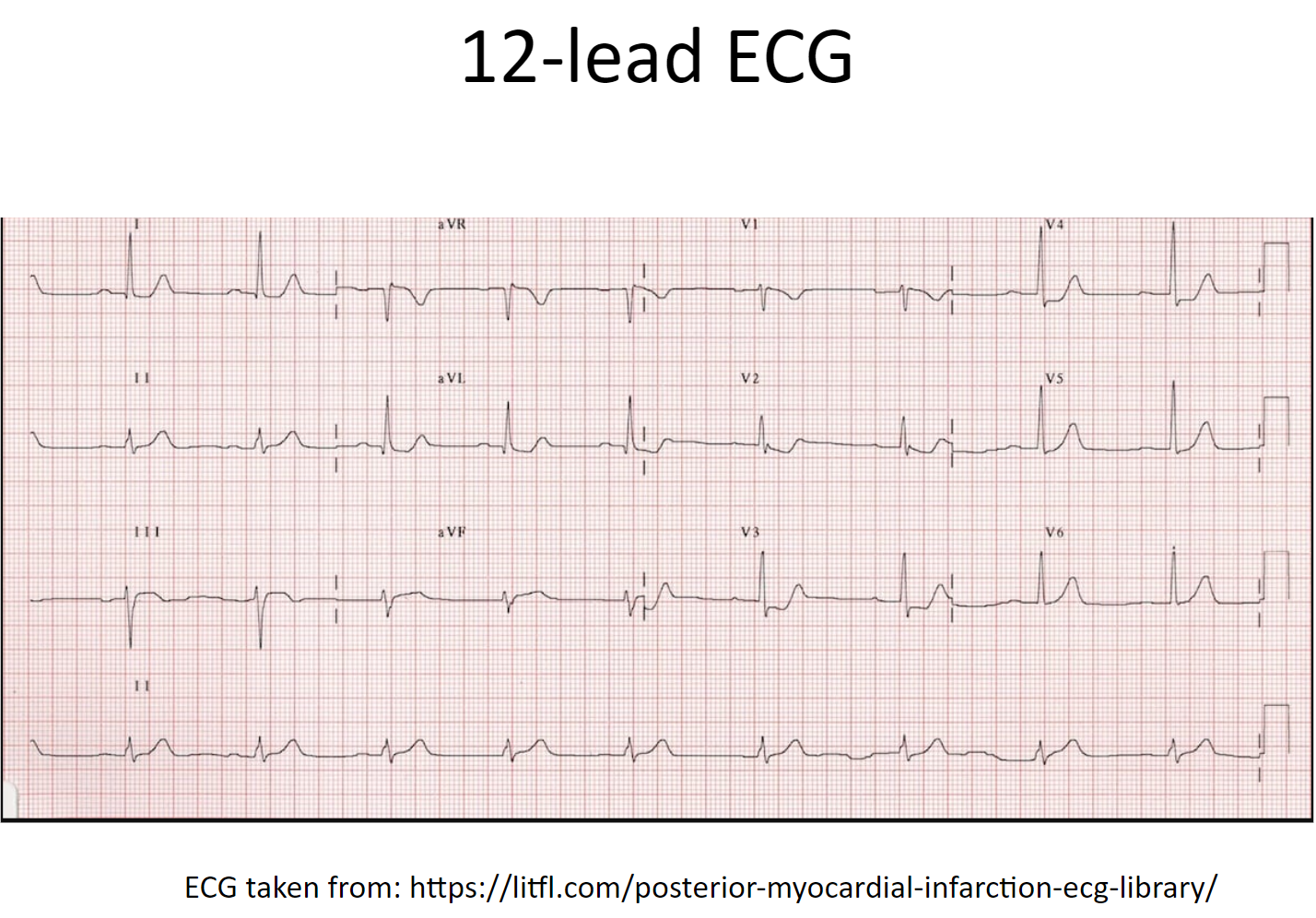ECG Case Posterior STEMI Manitoba ACS Network ecg-case-posterior-stemi-manitoba-acs-network