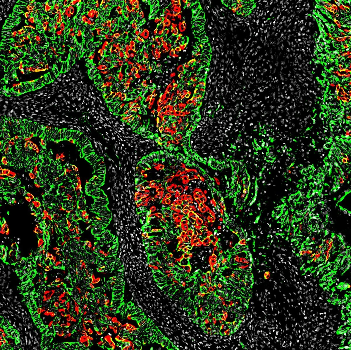 Human endometrial cancer with KRT5-positive cells (red)