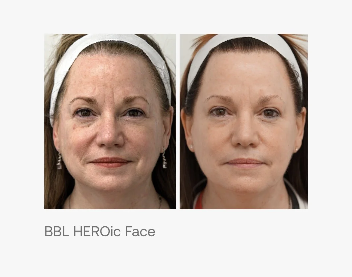 BBL™ Skin Treatment at Aesthetics 441
