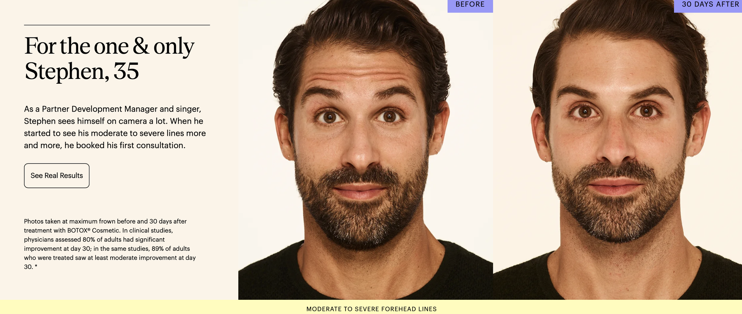 Side-by-side photos of a man showing his face before and after treatment for moderate to severe forehead lines, with the 'before' image on the left and the '30 days after' image on the right.