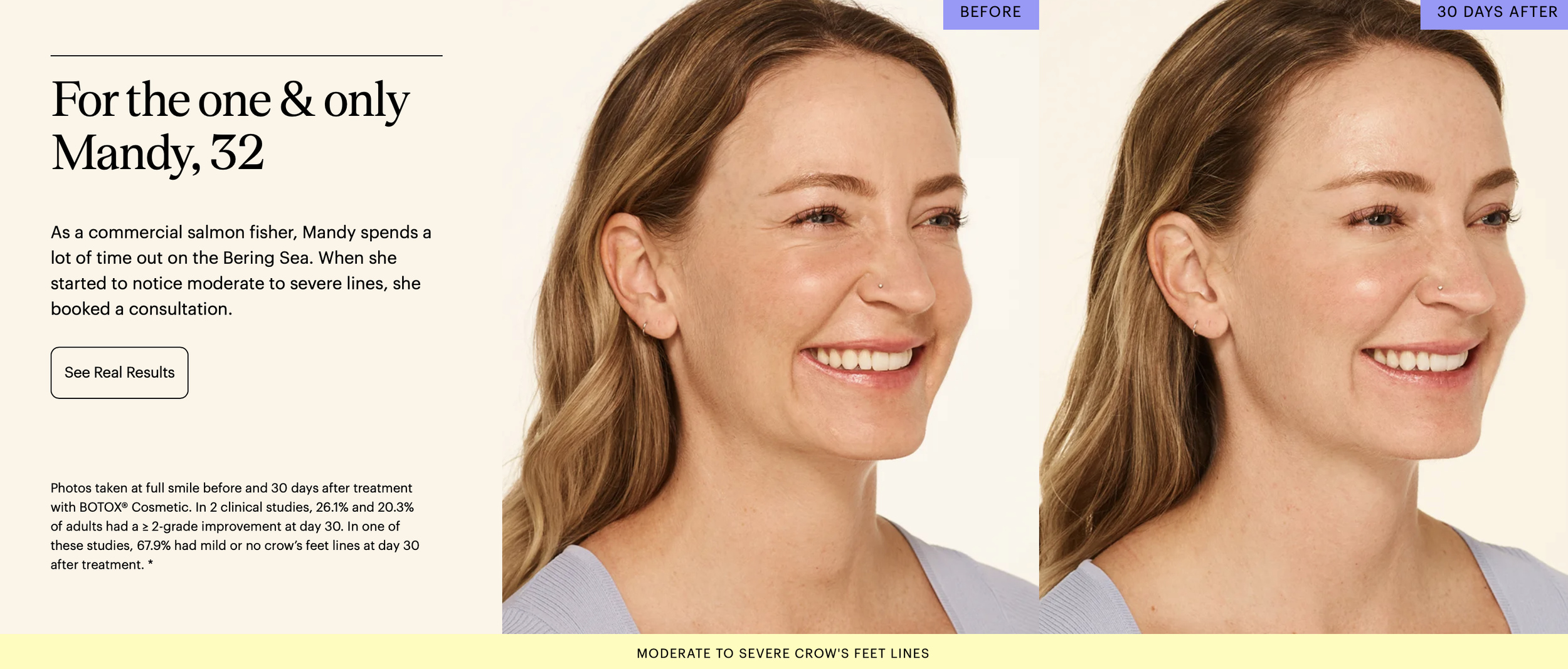 Before and after comparison photos of a woman showing reduced fine lines around her eyes and face 30 days after Botox treatment