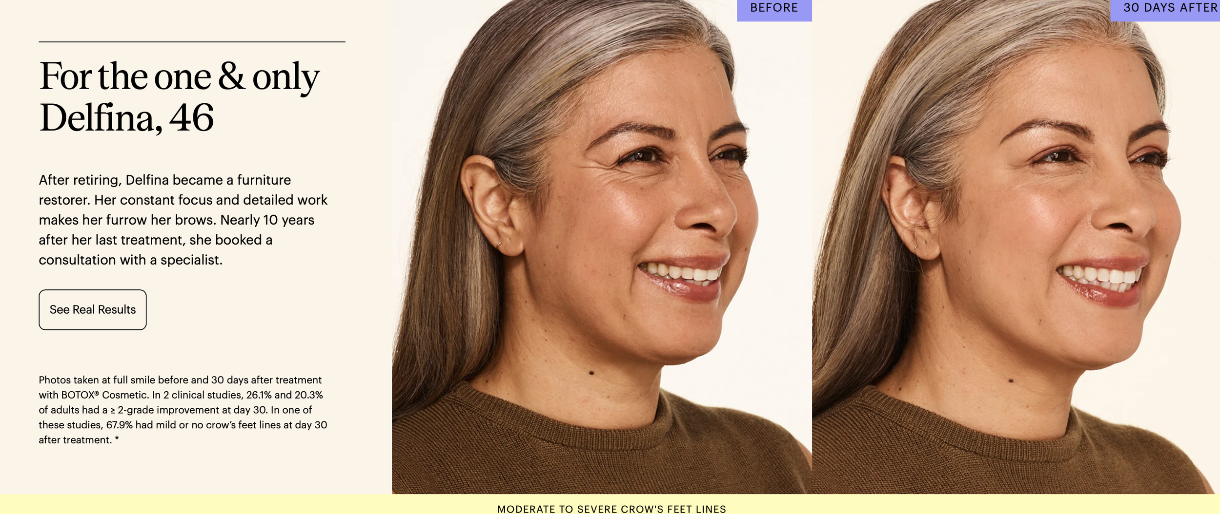 Side-by-side comparison of woman's face before and after 30 days of Botox treatment, showing reduced crow's feet and improved skin appearance.