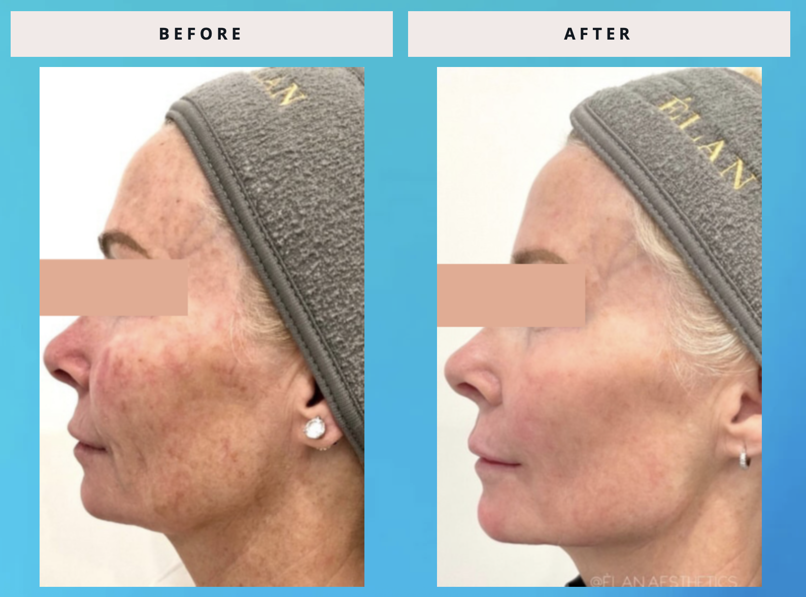 January Reset: Why Winter Is the Perfect Time for CoolPeel® (And Why You Can Glow All Year Long)