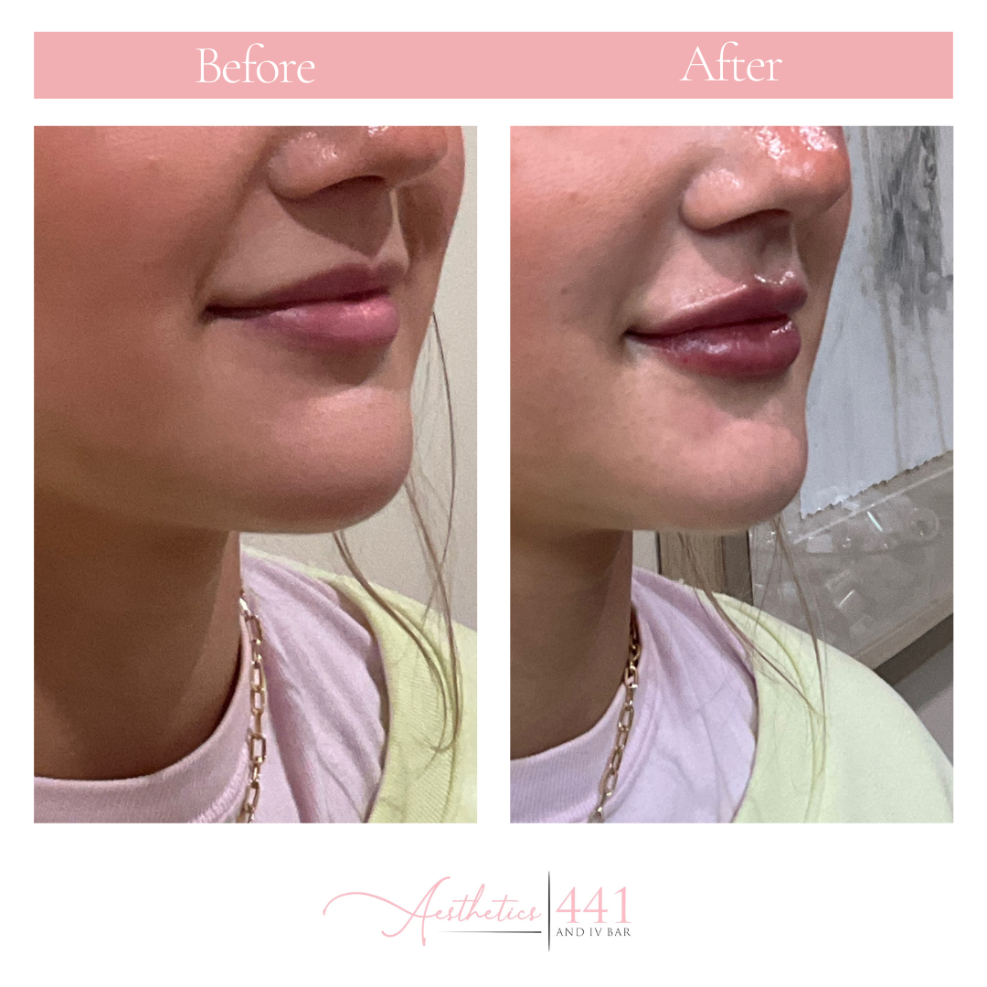 Lip Filler Gainesville GA: First Time Experience + Real Patient Results