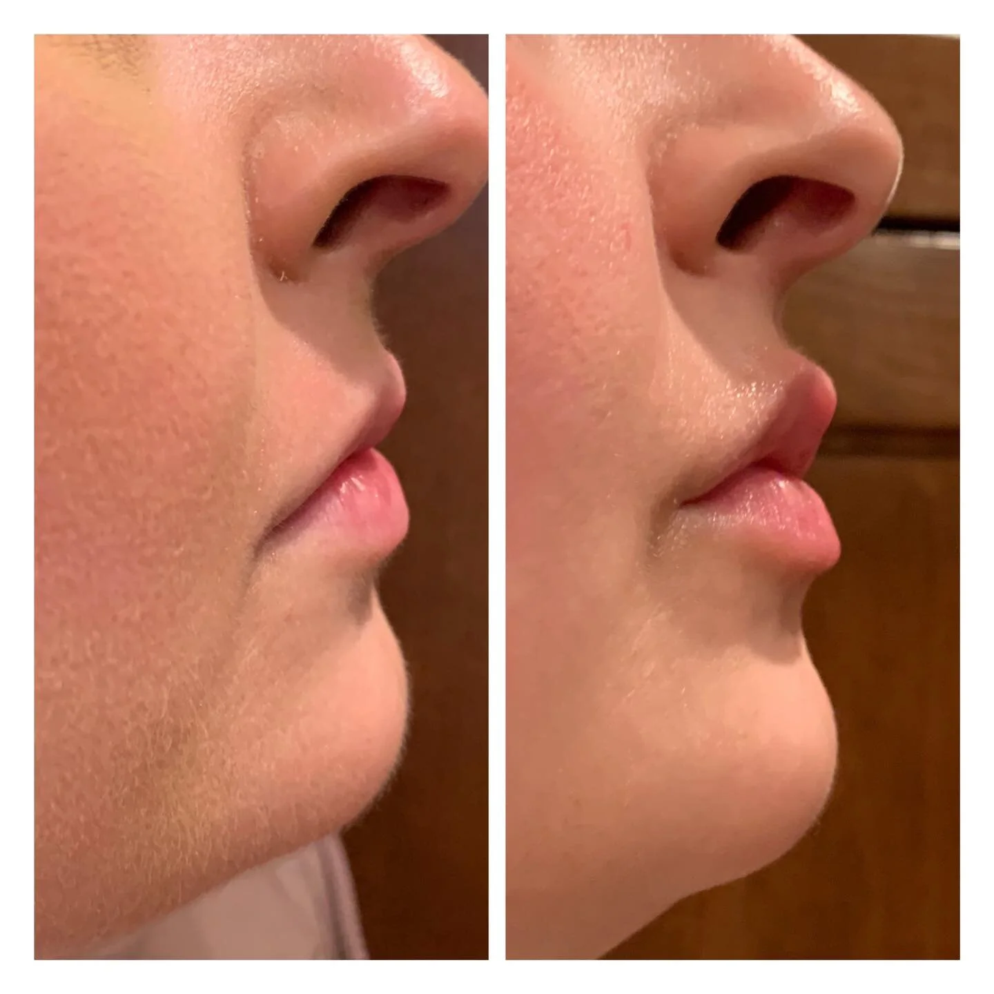 Oh those juicy lips post filler have got me swooning!!!!

#lips #plumpyourpout #kysse #lipaugmentation #lipfiller #medaesthetic #medaesthetics #skincarecommunity #skincare #nurseinjector #rochestermnmoms #beforeandafter