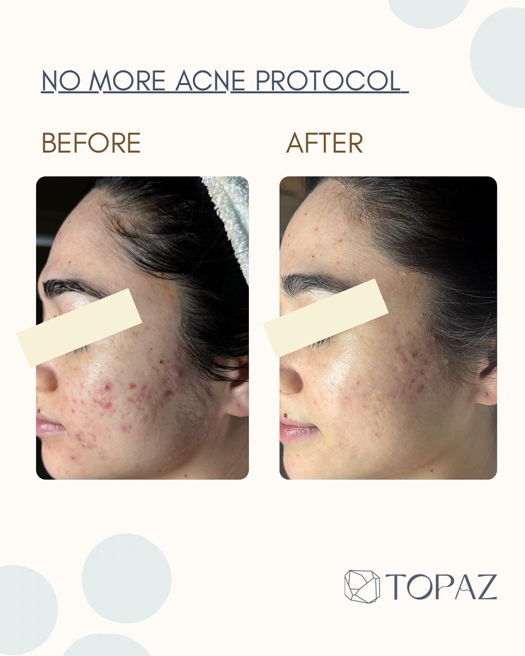 ✨ Real Skin Journey ✨ At Topaz Facial Studio, we specialize in treating acne and post-acne skin gently &mdash; without harsh medications or aggressive treatments. 💆&zwj;♀️

Swipe to see a beautiful transformation from one of our amazing clients. In 