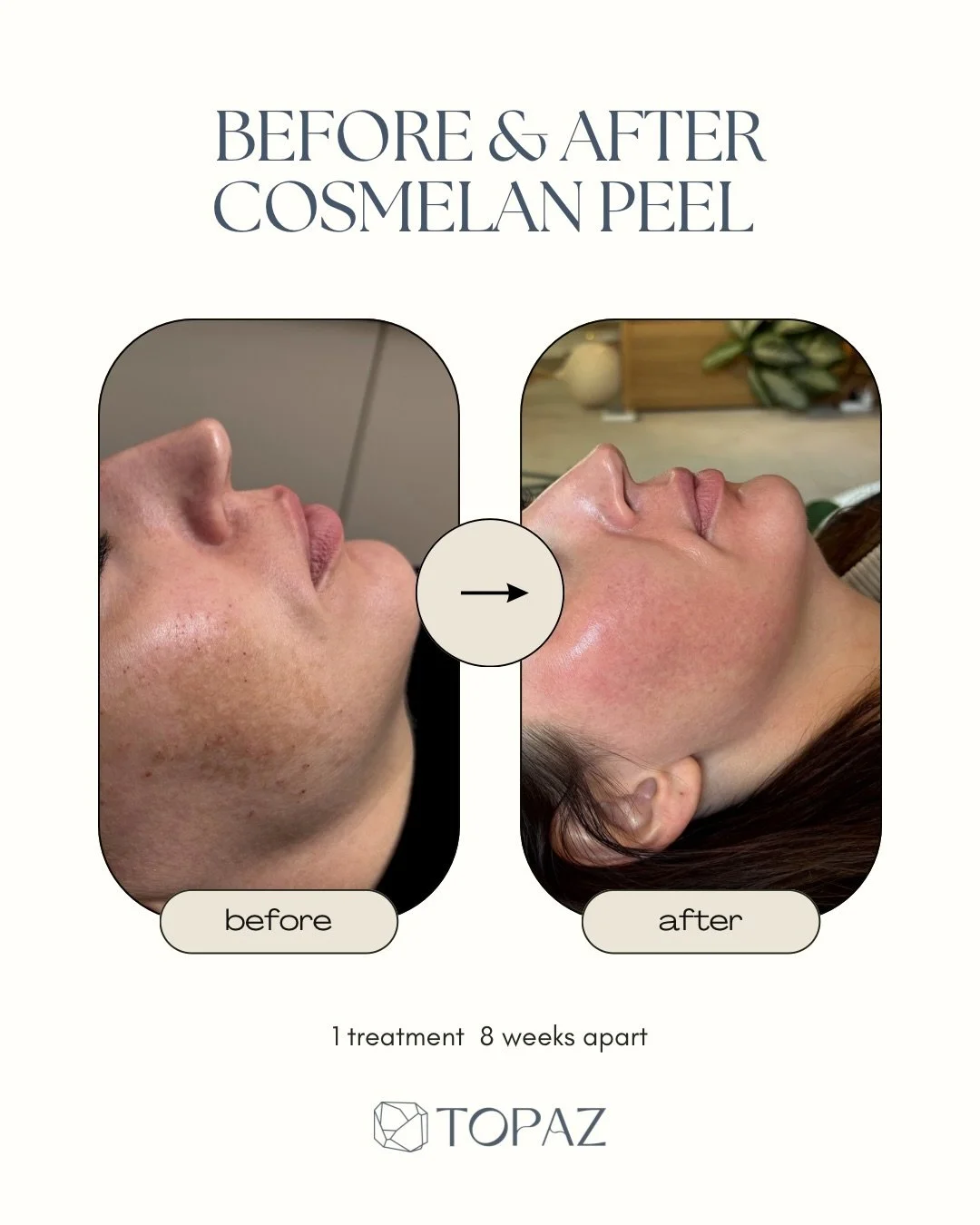 Swipe to see why Cosmelan is called the gold standard for pigmentation ✨

This medical-grade depigmentation peel works on the deepest layers of the skin to target:
&bull; Melasma
&bull; Sun spots &amp; age spots
&bull; Post-inflammatory hyperpigmenta