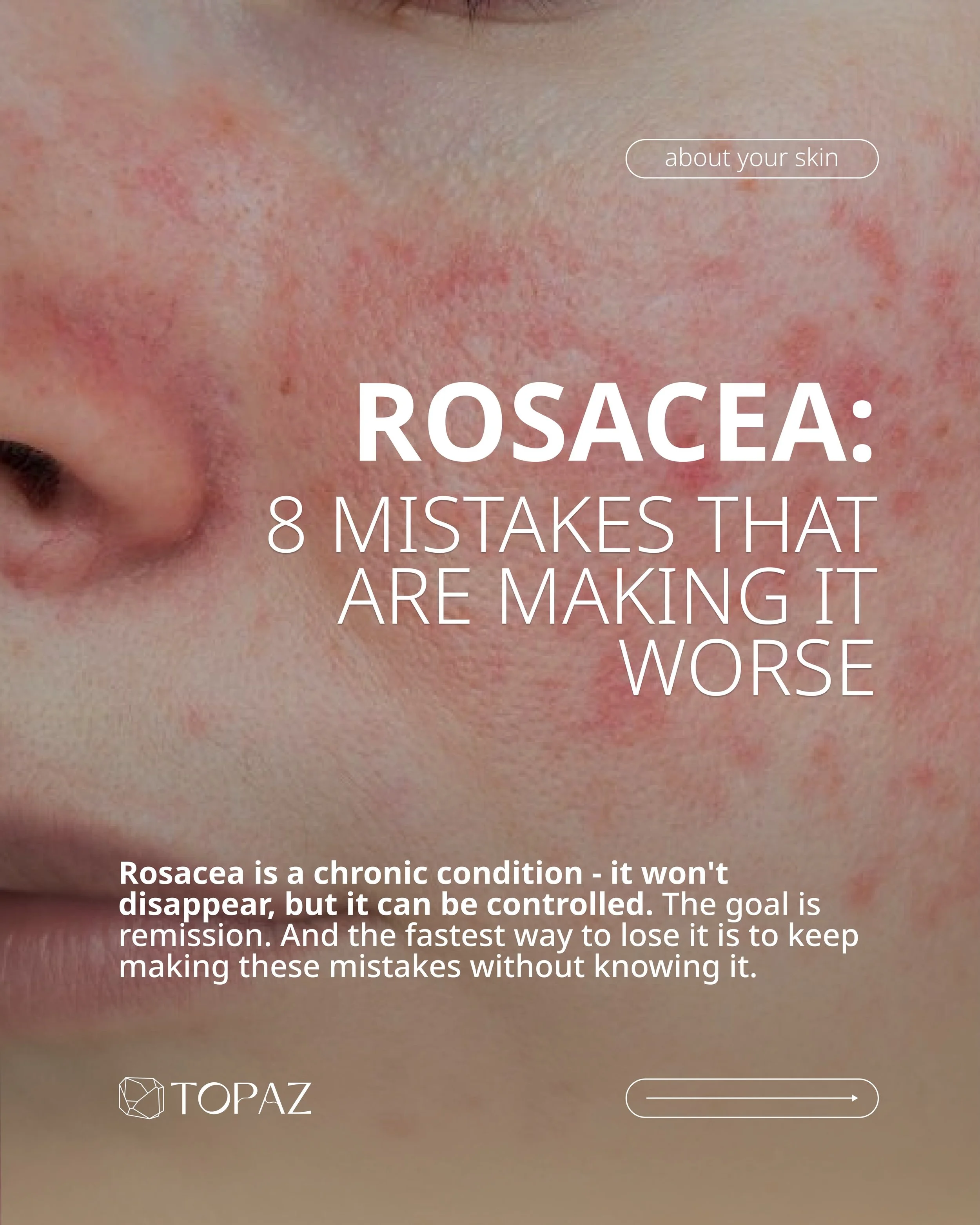 Rosacea can be controlled. But not if you keep doing these things. 

It&rsquo;s a vascular, inflammatory condition with a genetic root which means it responds to everything: heat, UV, stress, the wrong cleanser, physical exfoliation, skipped SPF.

Th