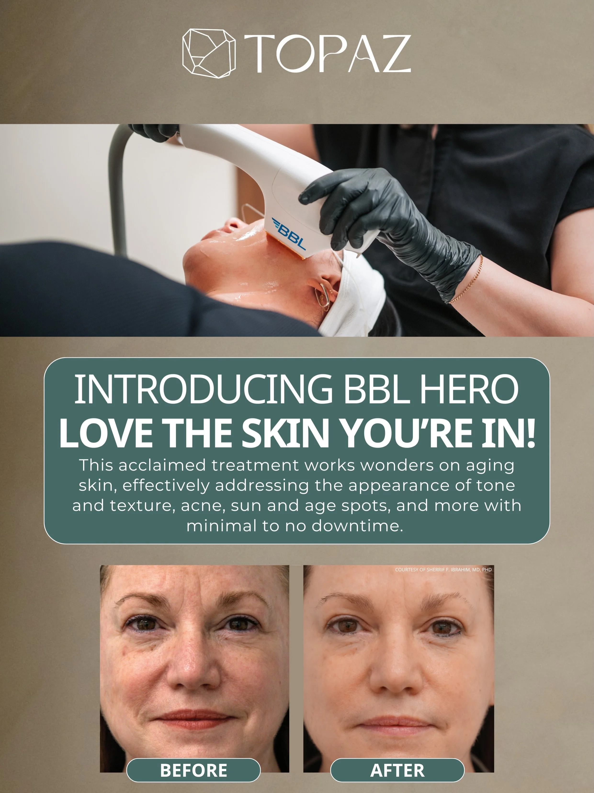Meet your skin&rsquo;s new favorite treatment - BBL HERO ✨

This advanced light therapy helps improve:
&bull; uneven skin tone
&bull; sun damage &amp; pigmentation
&bull; redness and acne
&bull; fine lines &amp; texture
&bull; overall skin radiance

