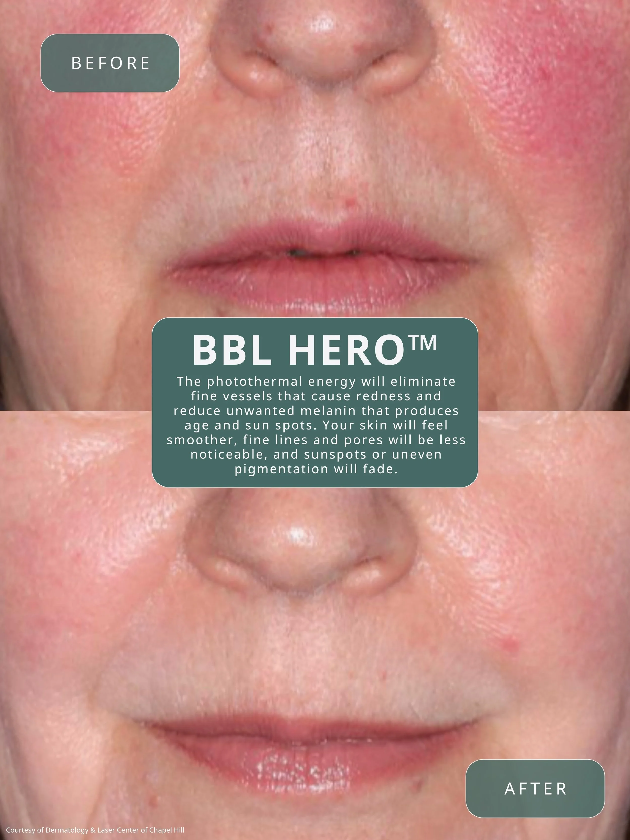 Redness, visible vessels, uneven texture, and signs of sun damage can make skin feel difficult to manage, but with the right treatment plan, real improvement is possible.

BBL HERO helps target:
▫️ Redness and rosacea-related flushing
▫️ Sun damage a