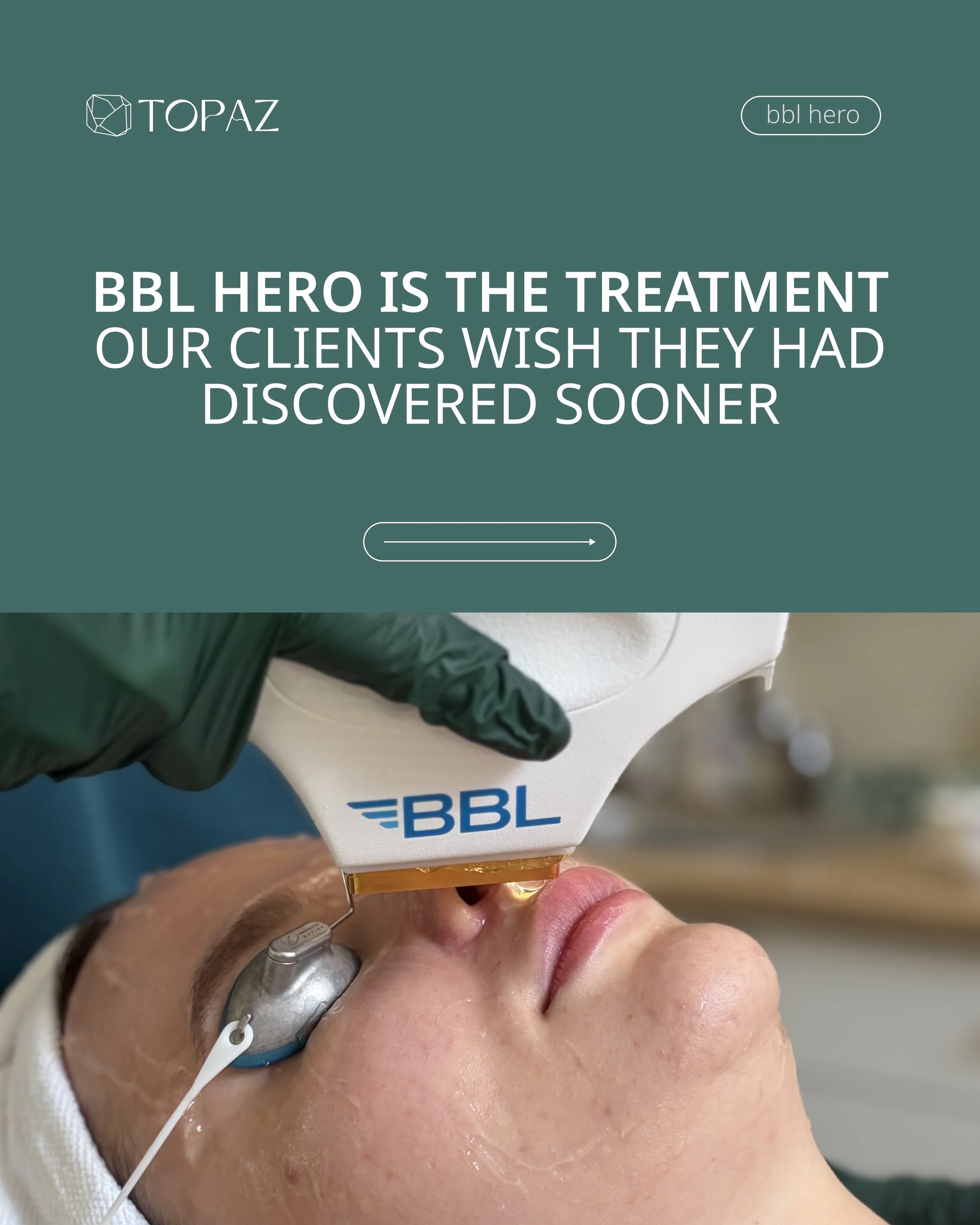 Pigmentation, redness, uneven tone, and loss of radiance don&rsquo;t appear overnight. They build up over time. The good news? Modern treatments like BBL HERO can help address visible signs of sun damage and restore a healthier-looking complexion.

S