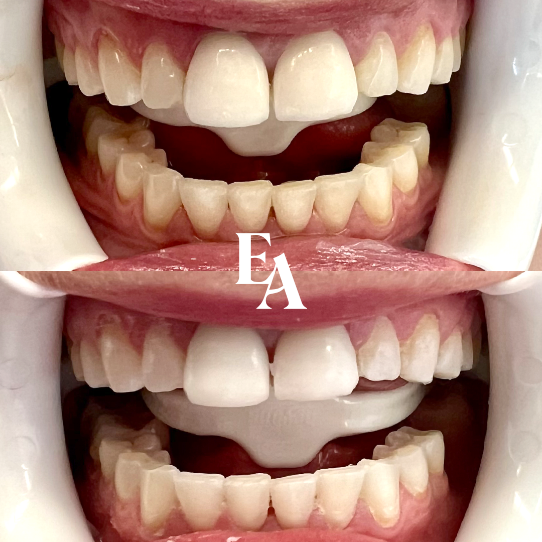 Teeth Whitening Before and After Edmonton.png