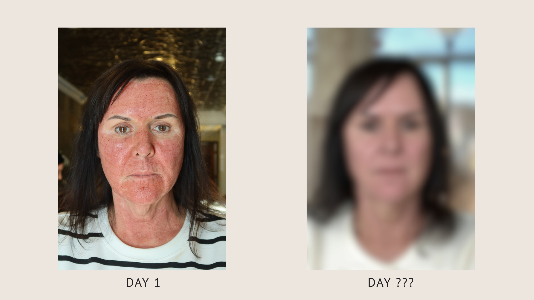 CO₂ laser resurfacing healing progression showing Day 1 redness and inflammation compared to healed skin results after treatment at External Affairs Med Spa