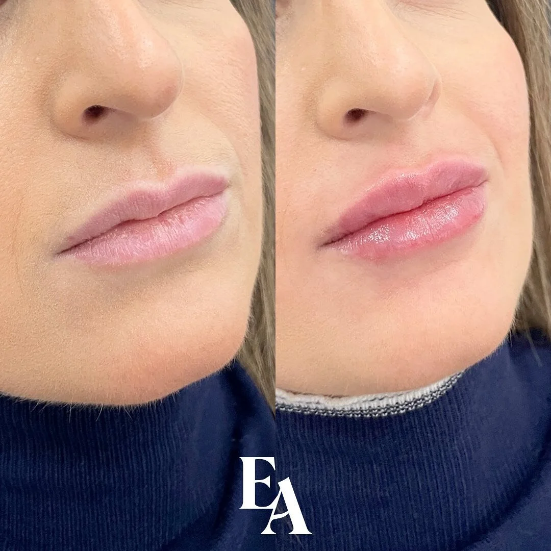 A beautiful, naturally plump, and balanced lip shape by @salinainjects! 😍💋

If you need a top up on your filler before any big events like weddings, grads, or vacations, now's the perfect time to stop in before summer. ✉️ DM us to reserve your next