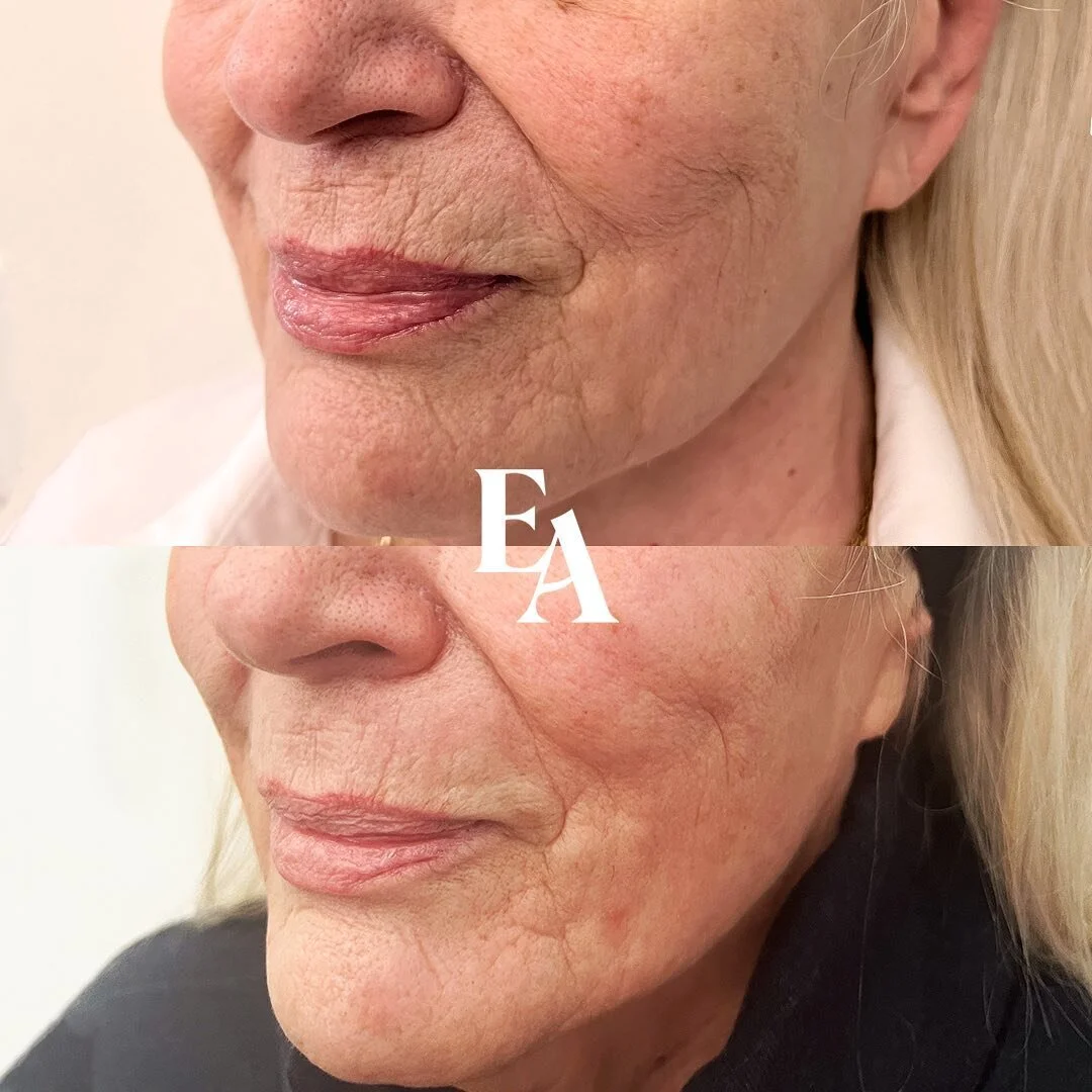 Check out these epic MiXto&reg; CO₂ Fractional Laser Resurfacing results! 🤩🪄 This lovely gal saw Carol for her treatments, who has 27+ years of clinical skin experience and knowledge.

Like a magic eraser for your skin texture, laser resurfacing is