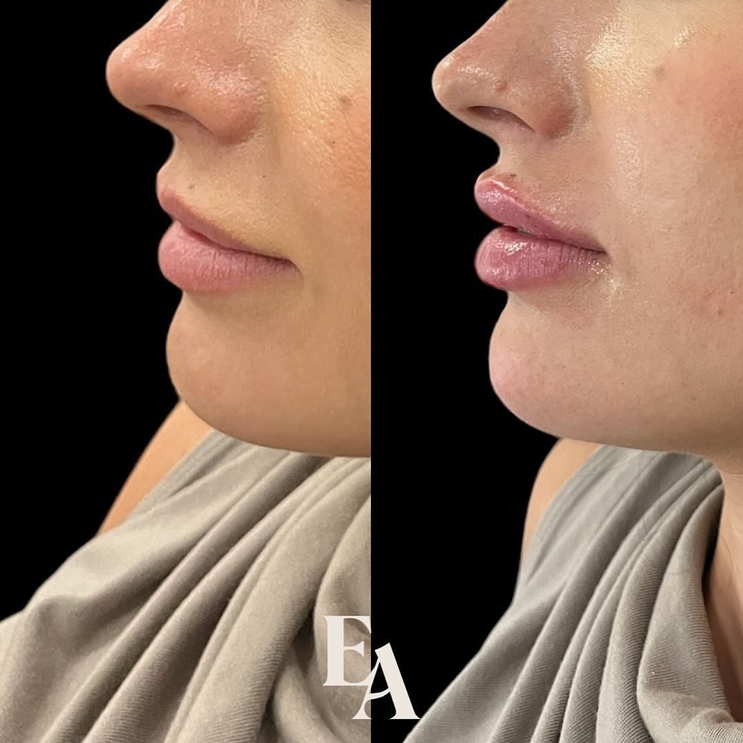 A moment of appreciation for the lip + chin filler duo 😍

Nurse Kaitlyn is a master at facial harmony and profile balancing. ✨📐 She&rsquo;s got openings this week if you&rsquo;re interested in meeting with her for a complimentary consultation to cr