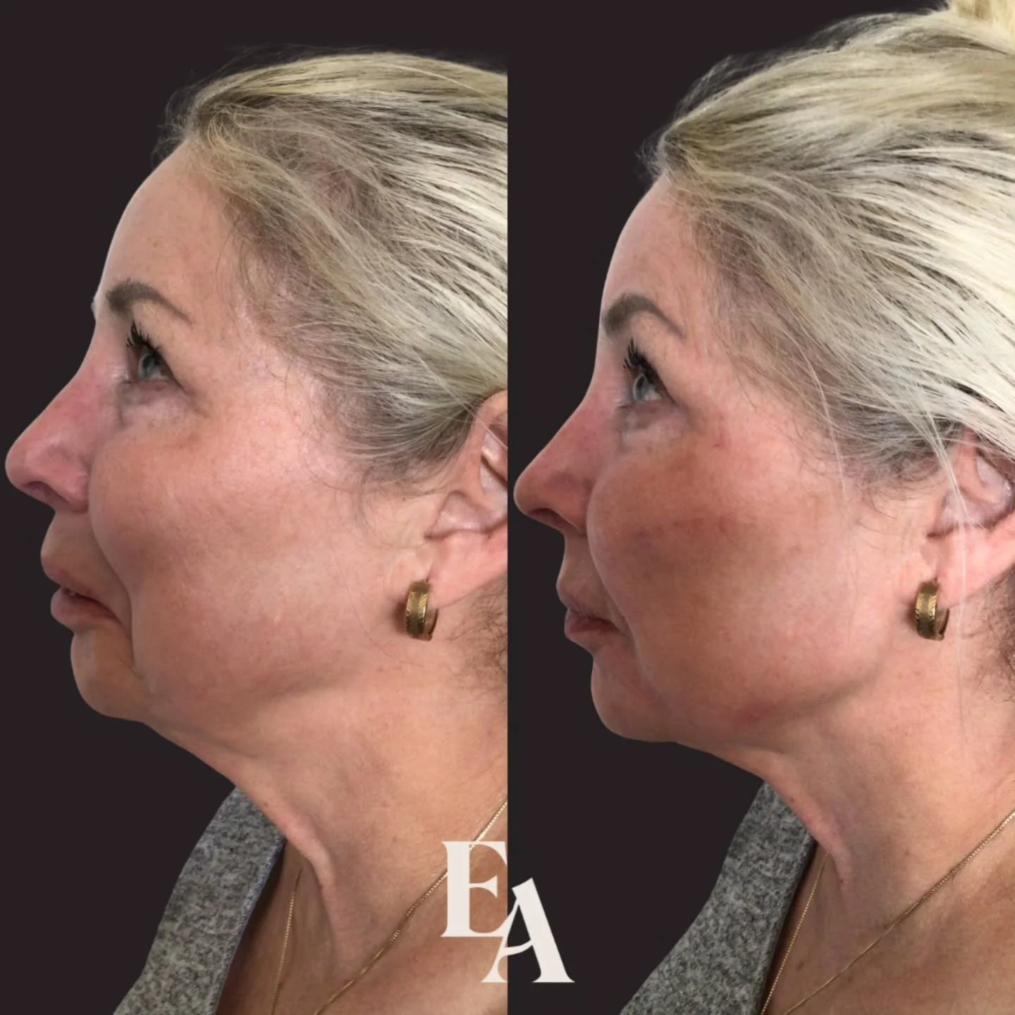 Another stunning transformation!

Our talented @nurse.janet.rn addressed this client's concerns about sagging, resulting in an elevated profile, a more supported mouth, and a beautifully refined jawline. All while keeping the results soft and natural