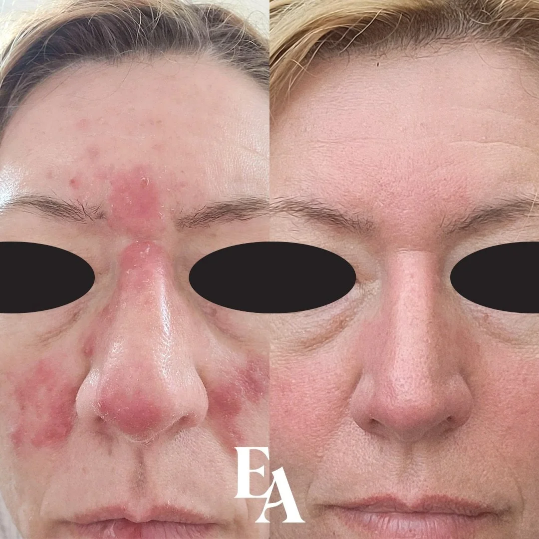 If you think skincare can&rsquo;t deliver dramatic results&hellip; look again 👀

This client had zero treatments 👏
No lasers.
No injectables.
Just a strategic, clinically-designed skincare routine.

And if you&rsquo;ve been waiting for the perfect 