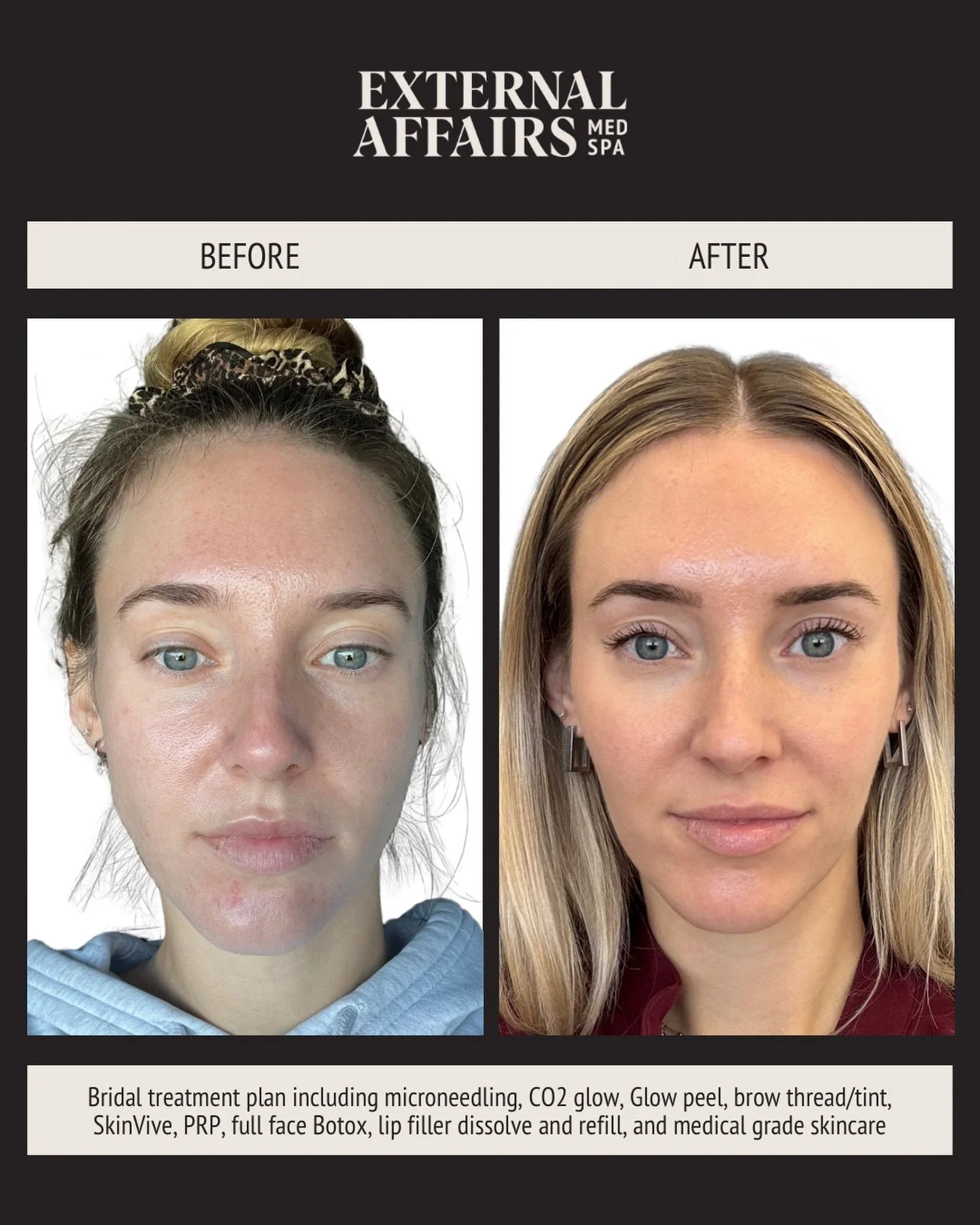 A beautiful bridal transformation 👰&zwj;♀️

This transformation belongs to our very own Kaitlyn, RN, who completed a full bridal treatment plan including microneedling, CO2 Glow, Glow Peel, SkinVive, PRP, Botox, medical grade skincare, and of course