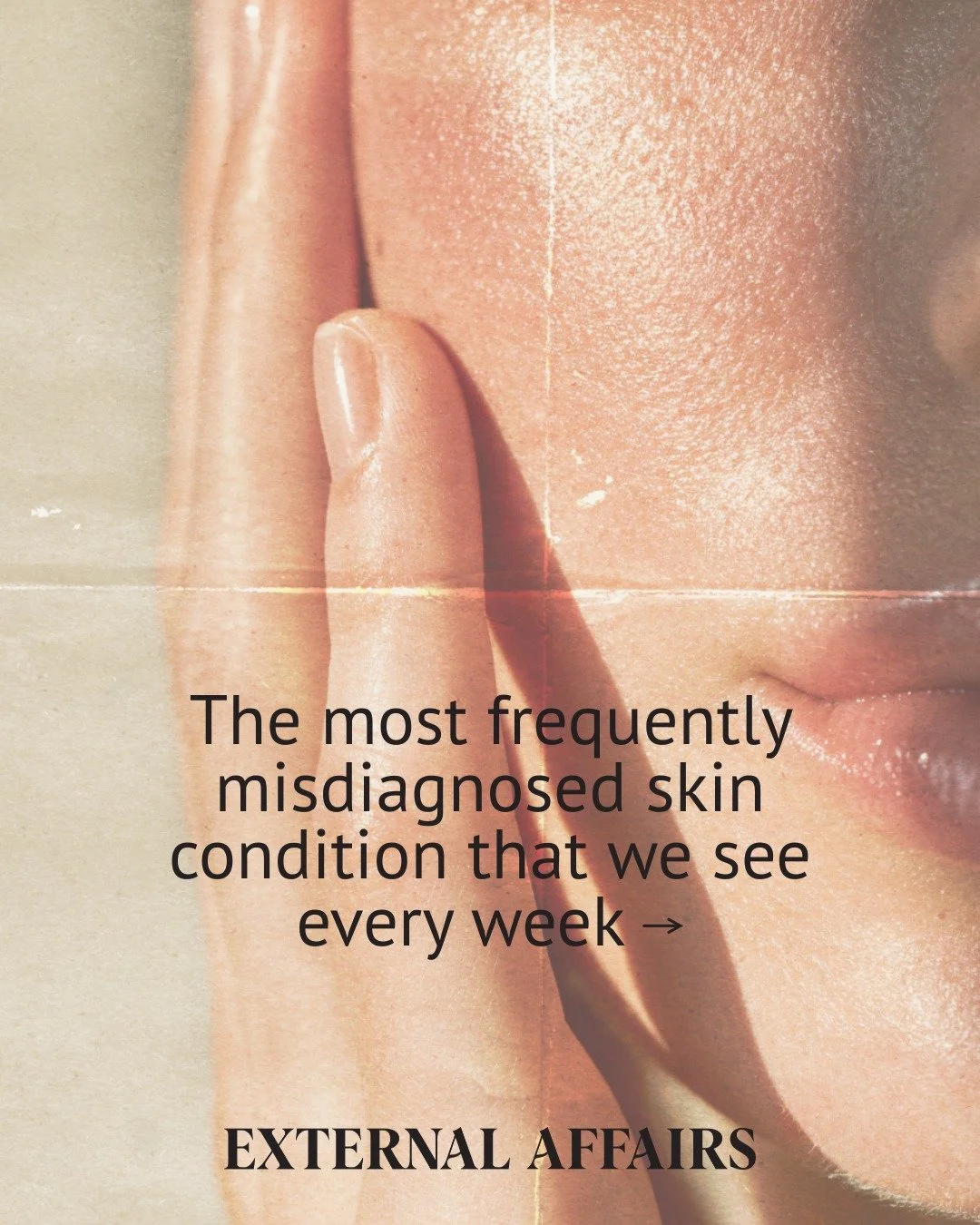 Not all bumps are acne. 👀

Milia, sebaceous hyperplasia, and rosacea show up in our clinic every week&mdash;and they all need very different treatment.

Swipe to learn what they actually are and why your acne routine isn&rsquo;t helping.

If you&rsq