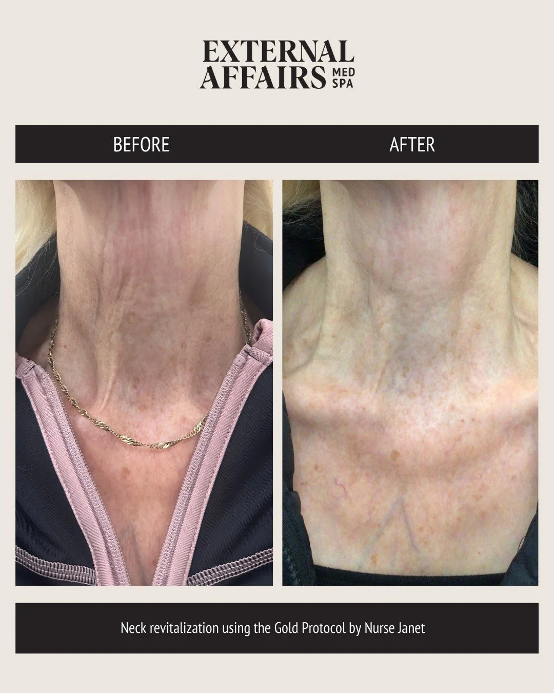 The neck is one of the hardest areas to treat and one of the most overlooked. Neck skin is thinner, more delicate, and has fewer oil glands than the face, which means it ages differently and needs a more strategic approach. That&rsquo;s why we don&rs