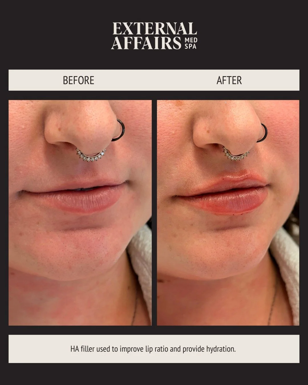 In case you didn't know, it's lip season 👄 Don't miss out on one of our most popular lip events of the year, see our last post or dm us for details!

These beautiful lips were done by @nurse.kaitlyn.rn and @aesthetic.nurse.samia

#lipfiller #lipfill