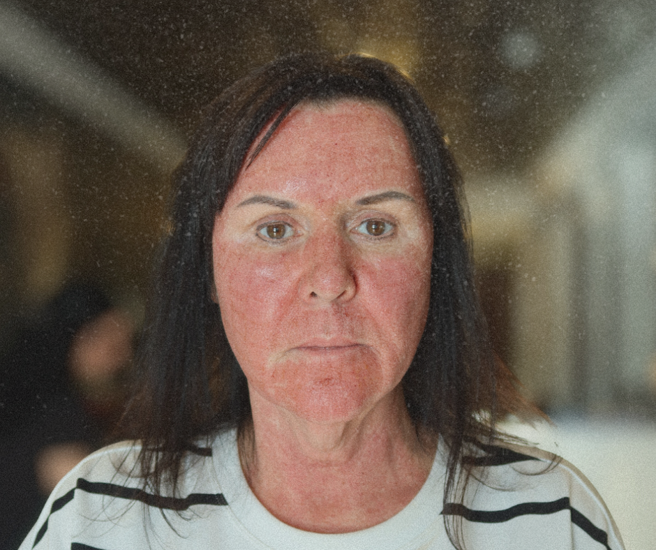 Is CO₂ Resurfacing Worth the Downtime?