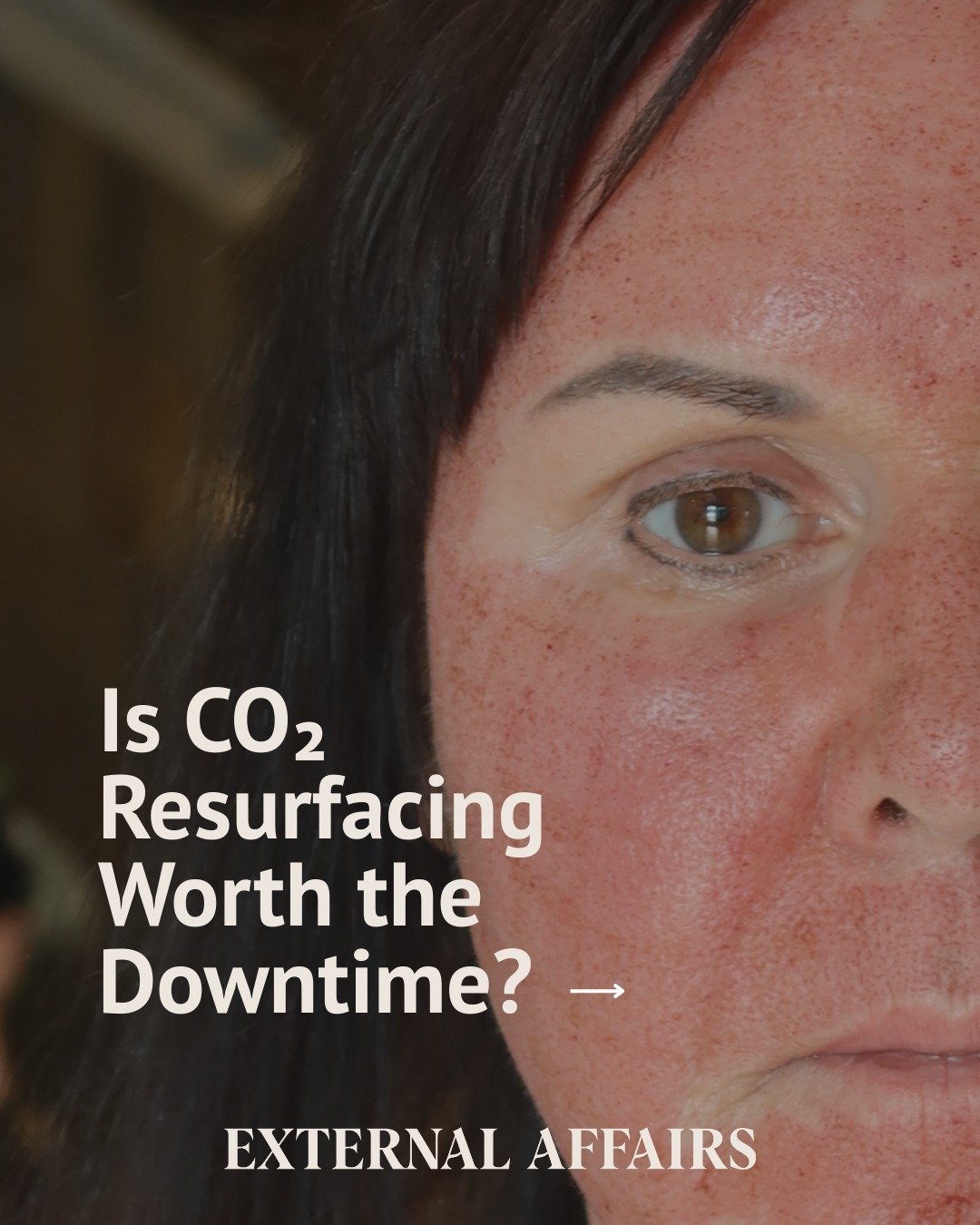 CO₂ resurfacing is less about &ldquo;how much downtime&rdquo; and more about what kind of change you&rsquo;re actually after 🖤

The level of resurfacing you choose determines how your skin heals, how long recovery lasts, and the kind of results you 