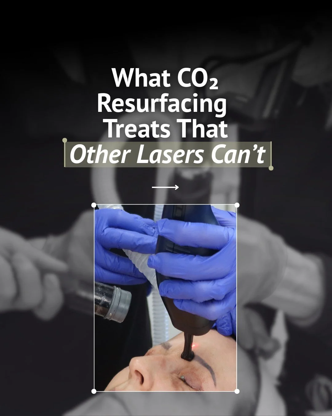 CO₂ isn&rsquo;t just about surface-level glow. It&rsquo;s about rebuilding your skin where it actually matters.

While lighter treatments can improve tone and brightness, CO₂ works deeper to target texture, scarring, fine lines, and overall skin qual