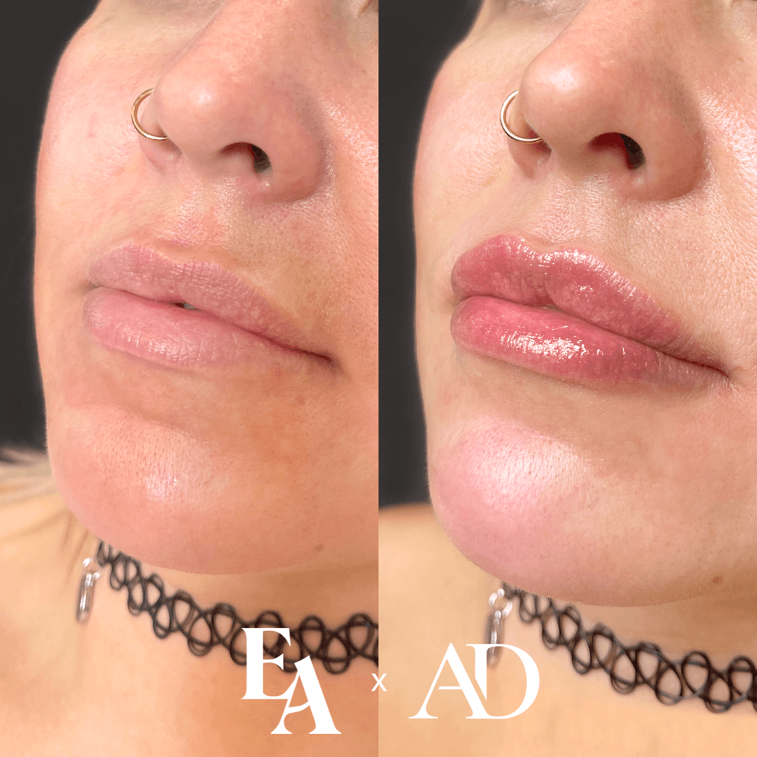 Lip Filler Experts in Edmonton, St. Albert & Kelowna — External Affairs