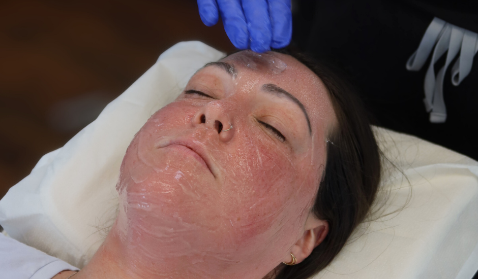 Medical-grade numbing cream being applied before Lutronic eCO₂ laser resurfacing treatment to ensure patient comfort.