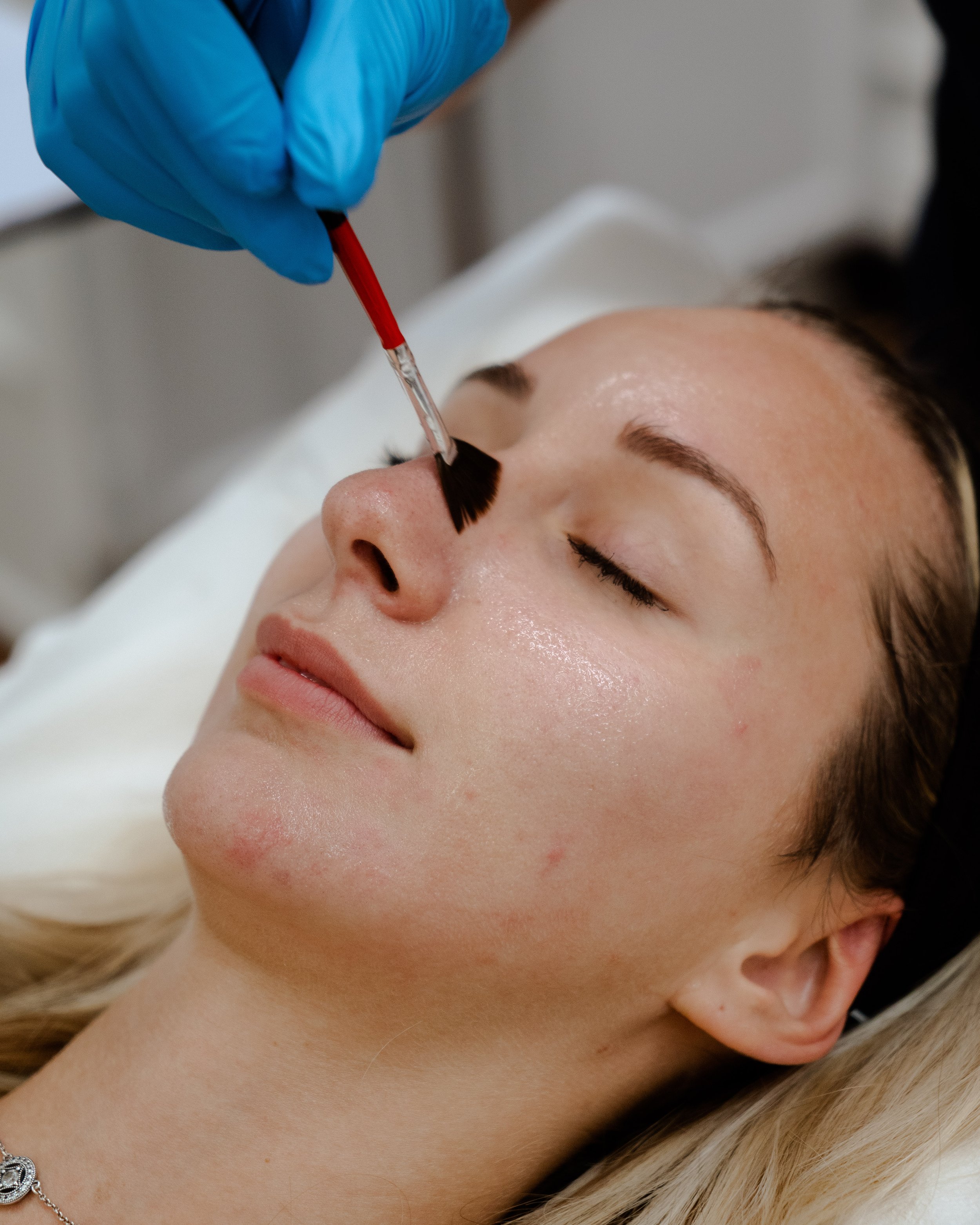 Woman getting chemical peel