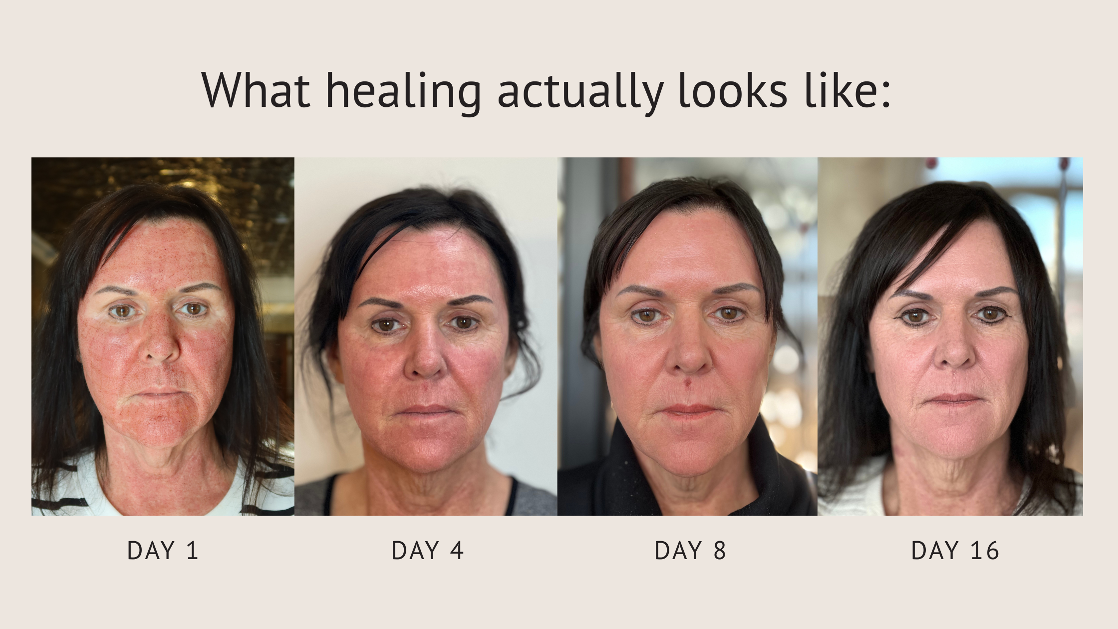 CO₂ laser resurfacing healing timeline from Day 1 to Day 16 showing redness, peeling, and gradual skin renewal under professional medical supervision at External Affairs Med Spa