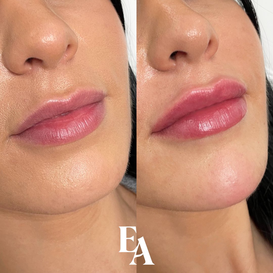 Lip Flip vs. Lip Filler What’s The Difference? — External Affairs